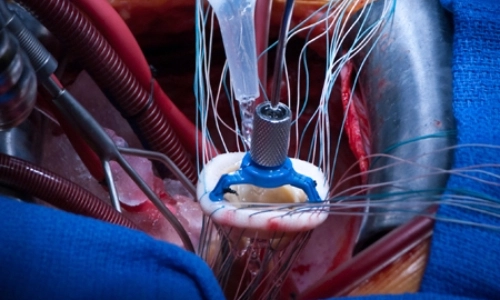 mitral valve