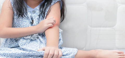 Largest paediatric trial investigates treatments for severe atopic dermatitis 