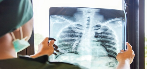 New national strategy progresses the fight against tuberculosis 
