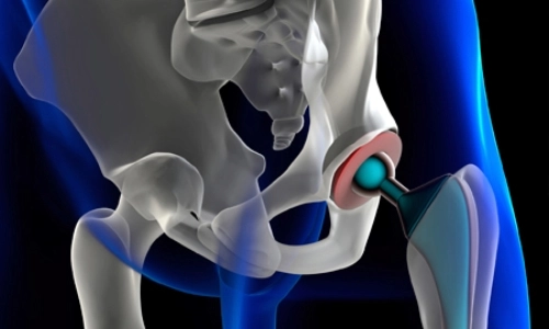 hip replacement