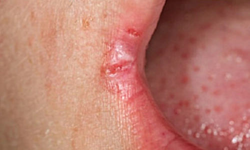 mouth with Angular Cheilitis