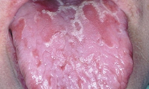 Geographic Tongue