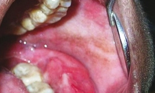 GingivalExtraNodularNonHodgkinLymphoma