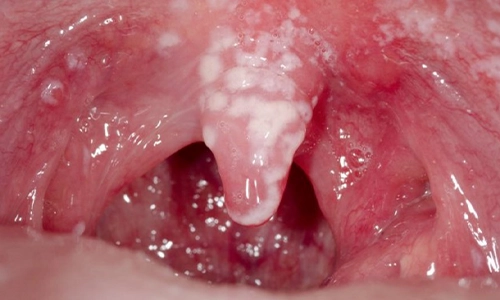 Oral-Candida