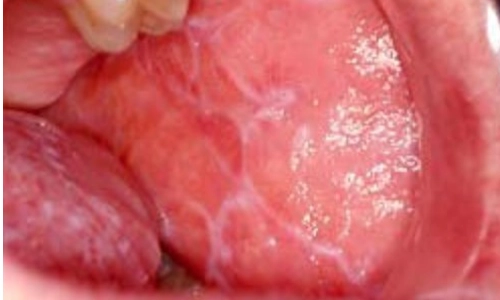 Oral-Lichen-Planus
