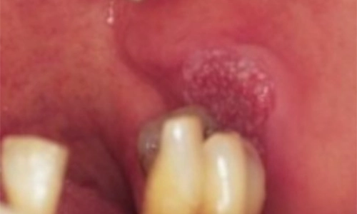 Retromolar-Trigone-SCC500by300