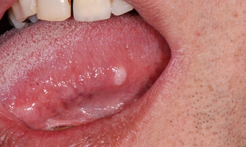 Stage One Oral SCC