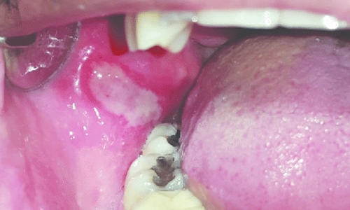 Traumatic-Ulcer