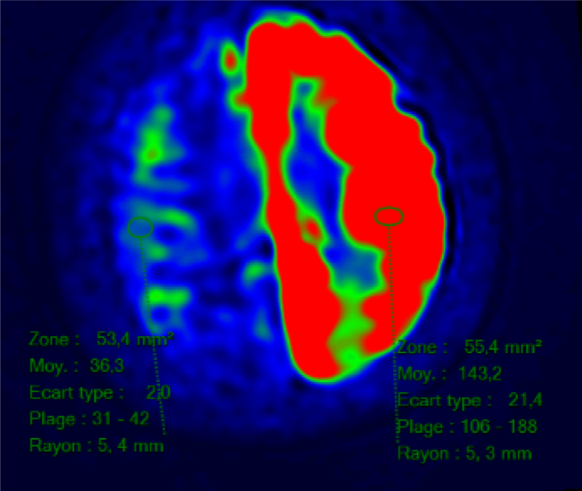 image of paralysis on one side of the brain