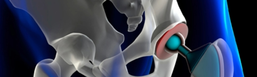A scan of a hip replacement