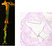 Atherosclerotic lesion area