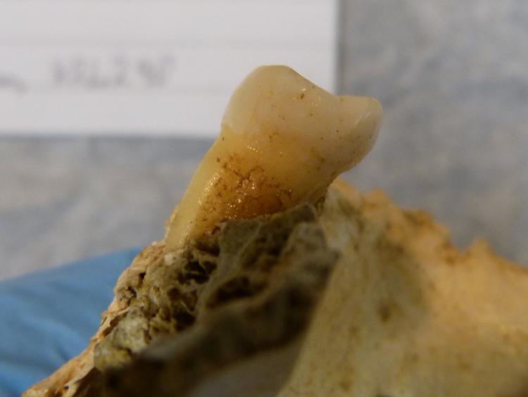 An old decayed tooth.