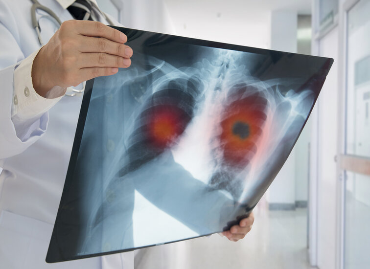 A person holds an X-ray image of a pair of human lungs