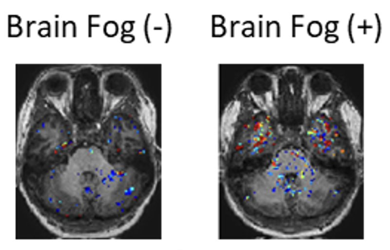 MRI scans in patients with Long-COVID with or without “brain fog”.  Increased “leakiness” of the blood vessels is seen in the temporal lobe region of the brain in those patients with brain fog (indicated by red signal).