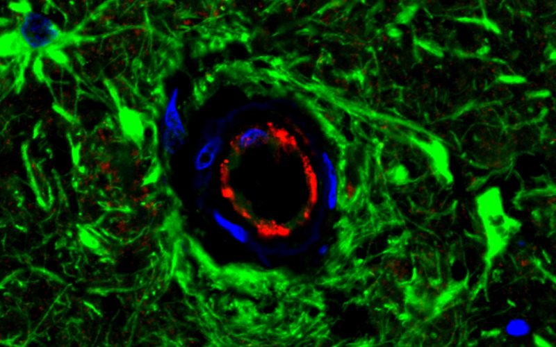Glial fibrillary acidic protein (GFAP) and Claudin-5 staining in the brain of a patient with ALSP.